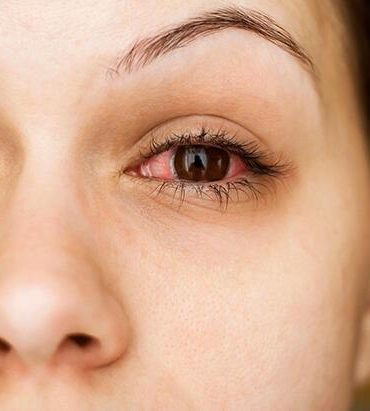 bahar-geldi-goz-alerjisi-basladi-kasimak-keratokonusa-sebep-olabilir-0eb3ee799389e98893135b1770f68898