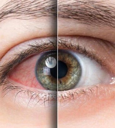 gozleri-bahar-alerjisinden-korumanin-8-yolu-ef74e025deaf1c87ac0db1e92b2740bc