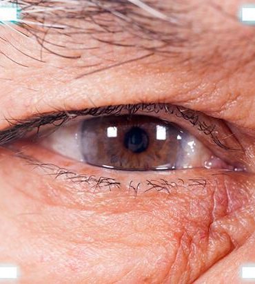 bulanik-gorme-ve-isik-hassasiyeti-ilk-belirtisi-kataraktla-ilgili-en-merak-edilenler-c0f1857207d0423df90499a1fd8d0cba (1)