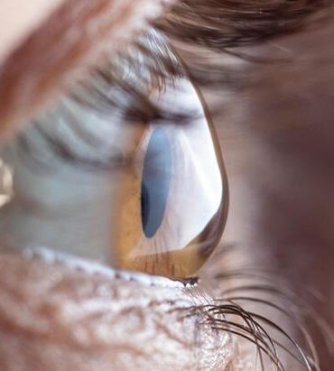 gozluk-degistiriyor-ama-hala-net-gormuyorsaniz-sebebi-keratokonus-aba3e46e8a53718056c5f44dbc5623da